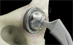 Depuy hip recall lawyer